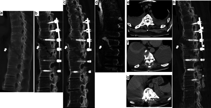Bilateral Massive Pleural Effusion Caused by Spinal Instability in Diffuse Idiopathic Skeletal Hyperostosis: A Rare but Potentially Serious Complication of Spinal Fracture.