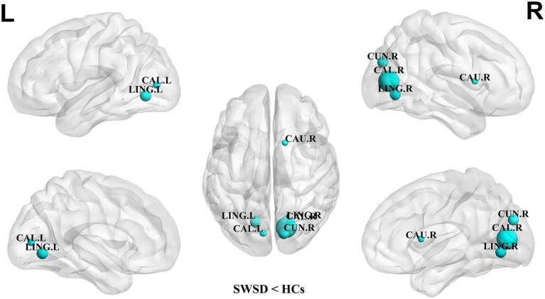 Altered functional network topology and connectivity in female nurses with shift work sleep disorder.