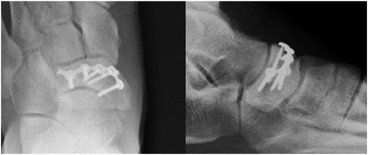 Surgical Treatment of Symptomatic Osteochondral Lesions of the Foot: A Contemporary Review.