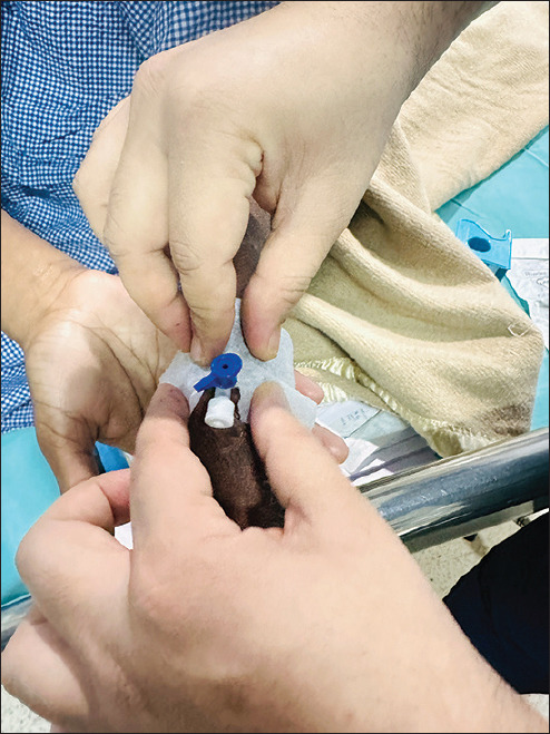 Anesthesia management of patients with ichthyosis vulgaris.