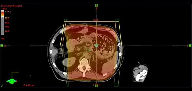 Early angiographic changes after hemostatic radiotherapy for gastric cancer bleeding, mentioning the mechanism and potential immediate effects of the treatment.