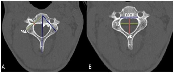 Morphometric Analysis of Subaxial Cervical Vertebra Pedicles in the Turkish Population.