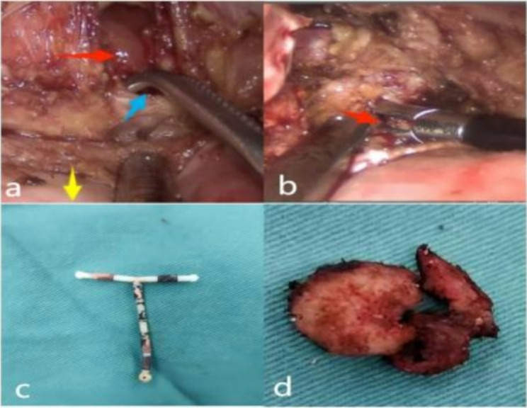 Vesicouterine fistula with vesical calculi secondary to IUD migration: a case report.