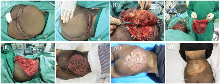 Surgical management of giant neurofibroma in a pediatric patient: A case report.