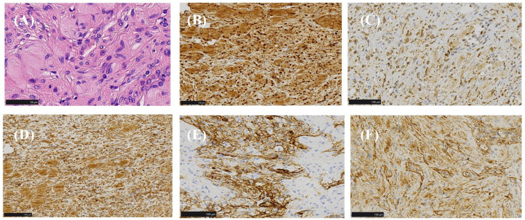 Surgical management of giant neurofibroma in a pediatric patient: A case report.