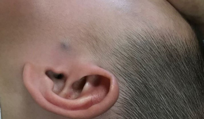 Clinical Features, Diagnostic Challenges, and Therapeutic Outcomes of 105 Pilomatricoma Cases.