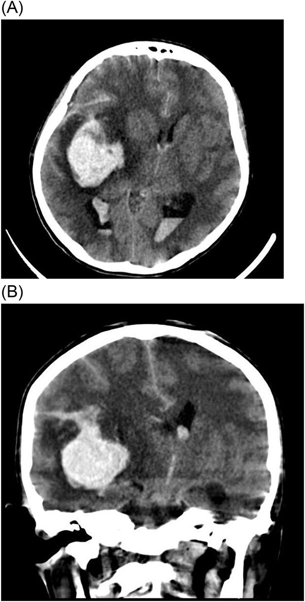 Ruptured intracranial Mycotic aneurysm following infective endocarditis in a young patient: a case report.