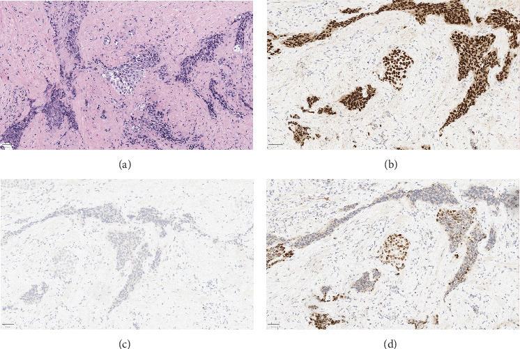 A Case of Malignant Priapism Secondary to Muscle Invasive Bladder Cancer and Review of Palliative Management.