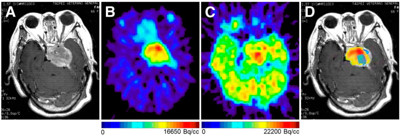 Optimizing Stereotactic Intracranial Neoplasm Treatment: A Systematic Review of PET Integration with Gamma Knife Radiosurgery.