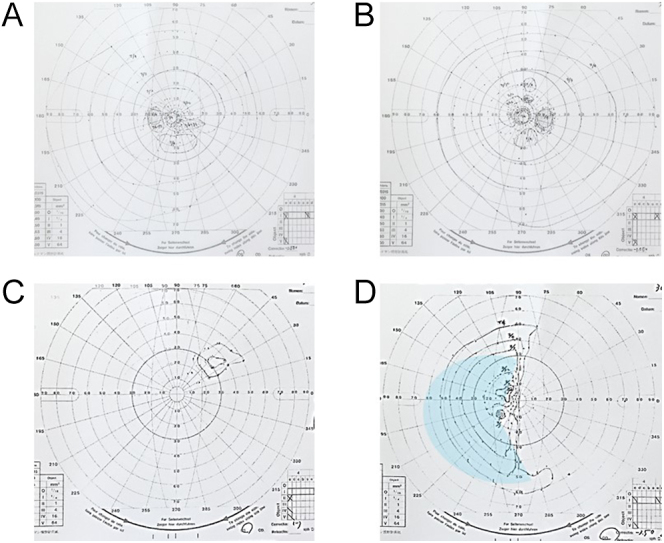 High-risk pregnancy complicated by craniopharyngioma: diagnosis in the context of visual impairment and tumor resection during pregnancy following IVF.