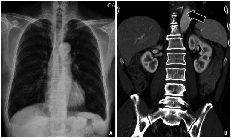 Foreign Body Ingestion: Radiologic Evaluation, Findings, and Management.