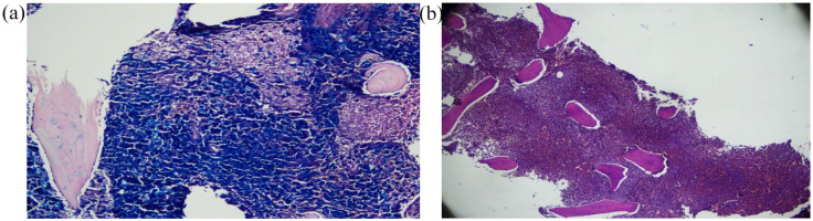 Chronic myeloid leukemia in a patient with beta thalassemia major: a rare presentation.