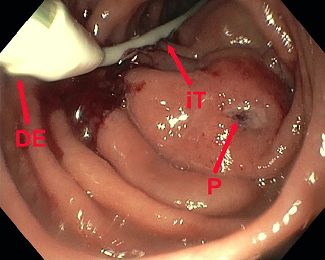 [Presentation of a new pre-emptive endoscopic treatment concept in duodenal interventions exemplified by an iatrogenic duodenal perforation after percutaneous transrenal nephrostomy. German version].