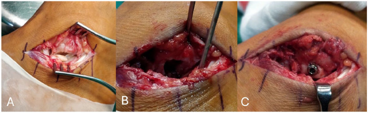 Surgical Treatment of Symptomatic Osteochondral Lesions of the Foot: A Contemporary Review.