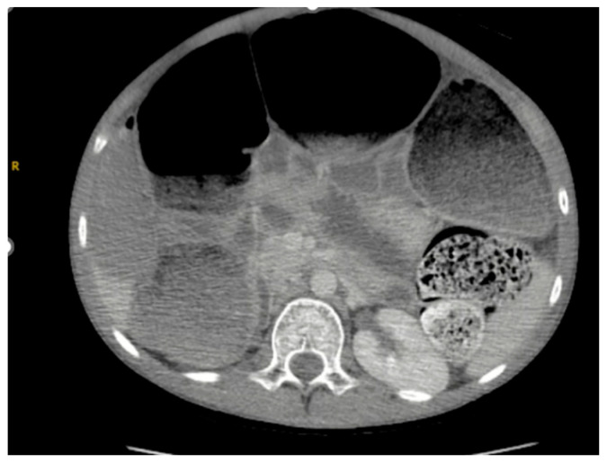 A Case Report of a Child with Constipation Diagnosed with Acquired Myenteric Hypoganglionosis.