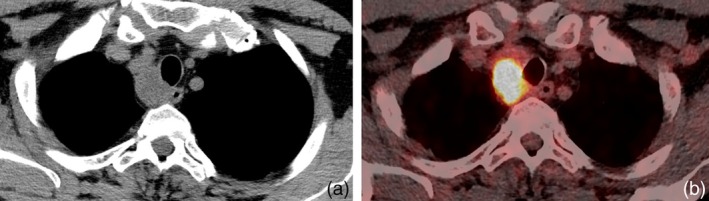 Silicosis Mimicking Lung Malignancy: A Case Series.