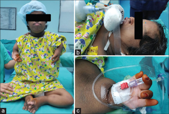 Role of point-of-care ultrasound in the anesthetic management of Roberts syndrome for cleft surgery.