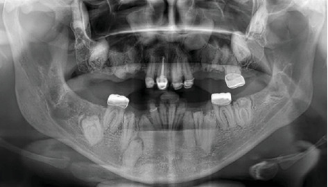 Generalized Odontodysplasia: A Case Report of the Oldest Reported Patient.