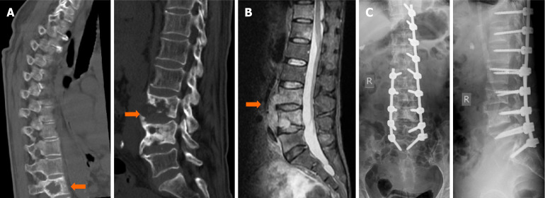 Treatment of lumbar tuberculosis with minimally invasive anterior lesion clearance combined with posterior fixation.