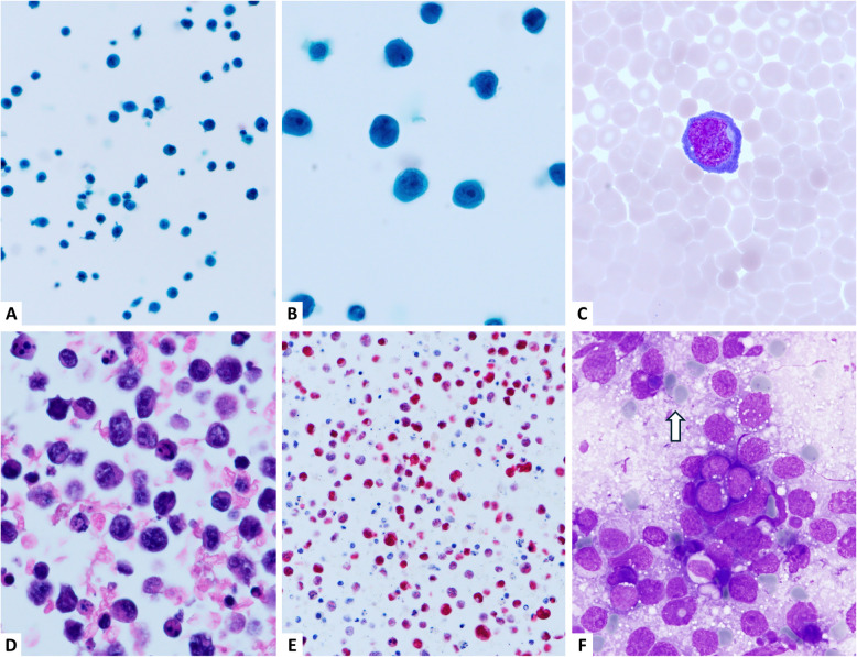 Effusion cytology of EBV-associated lymphoma: a concise review.