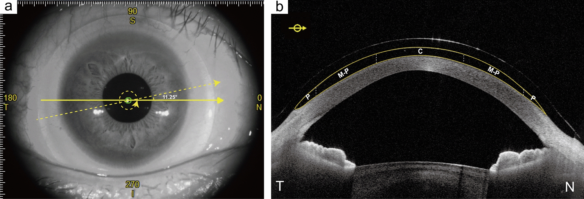 Wide-angle fluid reservoir thickness changes during short-term scleral lens wear.