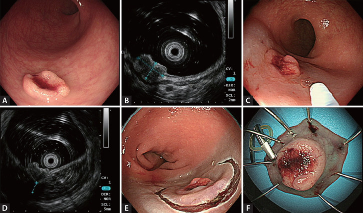 Submucosal saline injection and mini-probe endoscopic ultrasound to assess endoscopic resectability of colorectal subepithelial tumors.