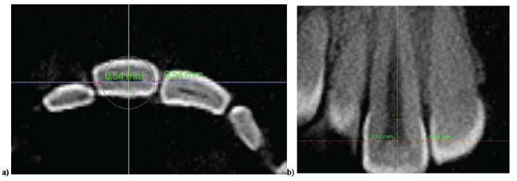3-Dimensional Evaluation of Enamel Thickness to Guide Orthodontic Interproximal Reduction: A CBCT-Based Study Across Gender and Ethnicity.