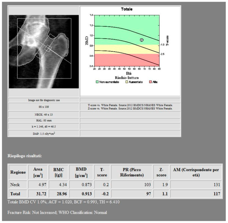 Bone Mineral Density (BMD) Assessment Using Dual-Energy CT with Different Base Material Pairs (BMPs).