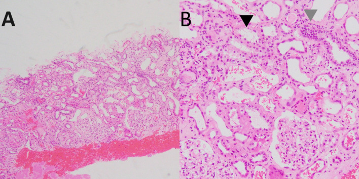 Fanconi syndrome induced by red yeast rice supplement.