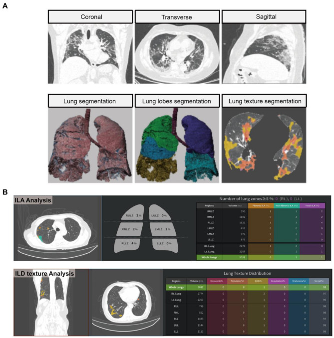 Integrating CT radiomics and clinical features using machine learning to predict post-COVID pulmonary fibrosis.