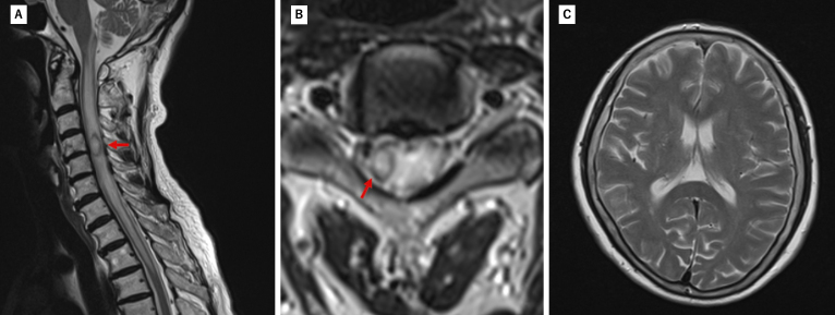 Rapidly Progressive Impaired Consciousness in Cervical Intramedullary Spinal Cord Abscess: A Case Report.
