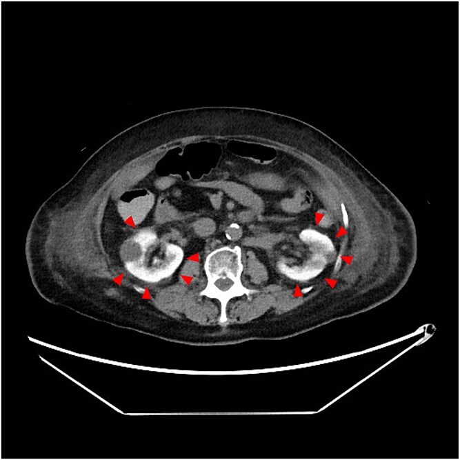 Bright kidney: a sign of contrast induced nephropathy after percutaneous coronary intervention.