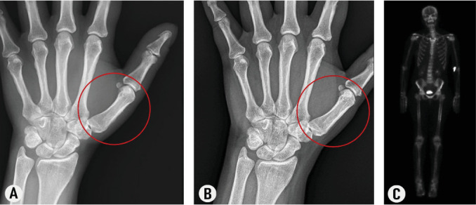 Resolution of Thyroid Acropachy in a Patient Treated With Teprotumumab: A Case Report and Review of Mechanisms.