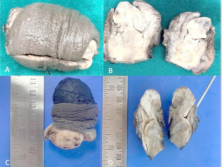 Clinicopathological features and reclassification of penile squamous cell carcinoma according to WHO classification 2022 for penile carcinoma with p16 immunohistochemical expression and its prognostic impact.
