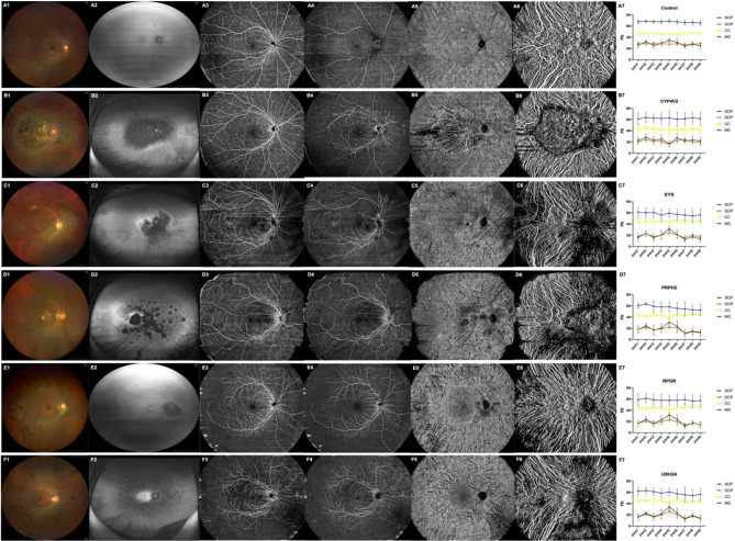 Genotype-specific retinal and choroidal perfusion patterns in inherited retinal diseases: an SS-OCTA analysis.