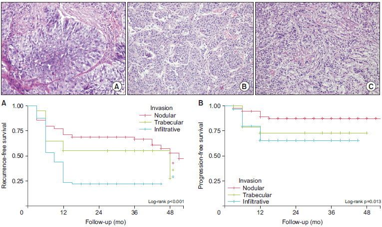 Predictive value of tumor invasion patterns on intravesical bacillus Calmette-Guérin response for stage T1 high-grade non-muscle-invasive bladder cancer.