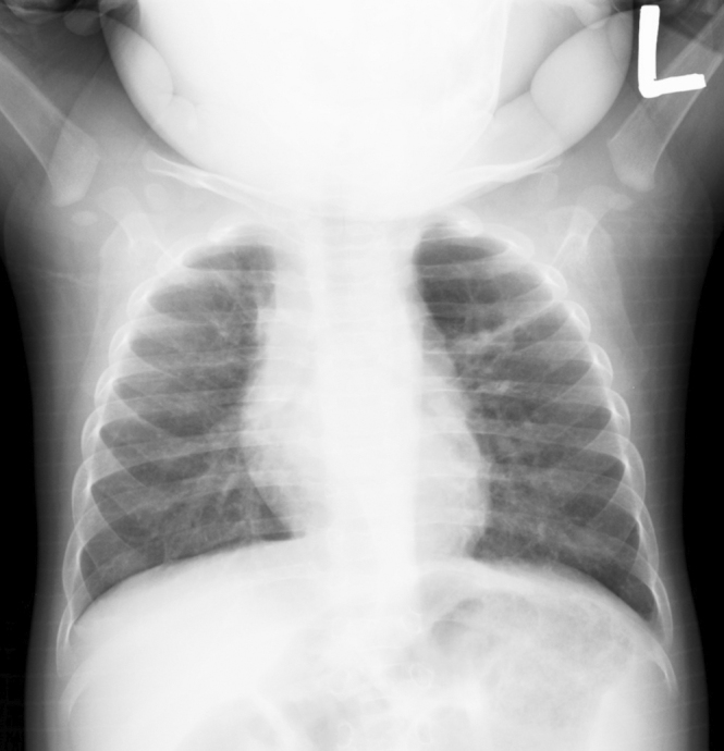 A Case of Asymptomatic Juvenile Emphysema.