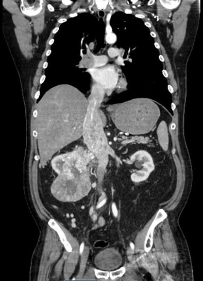 The atrial mass without an auscultatory "plop": renal cell carcinoma presenting with cardiac syncope-a case report.