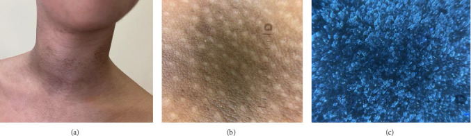 Terra Firma-Forme Dermatosis: Clinical Insights, Dermoscopic and Ultraviolet-Induced Fluorescence Dermoscopy Findings-A Case Report and Literature Review.