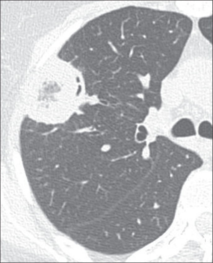 Reversed halo sign on chest computed tomography: a retrospective analysis of 286 cases.