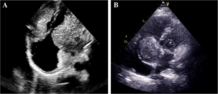 Cardiac tumors: clinical presentation, diagnosis, reatment, and results.