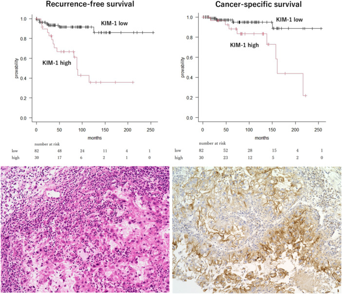Kidney Injury Molecule-1 Expression in Pathological T1b Clear Cell Renal Cell Carcinoma: A Putative Biomarker of High Immune-Inflamed Status and Recurrence.