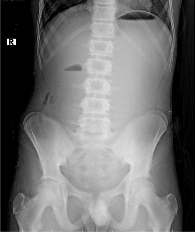 Combined Superior Mesenteric Artery Syndrome and Nutcracker Syndrome in a Young Male Patient Presenting as Atypical Vomiting and Rapid Weight Loss: A Case Report.
