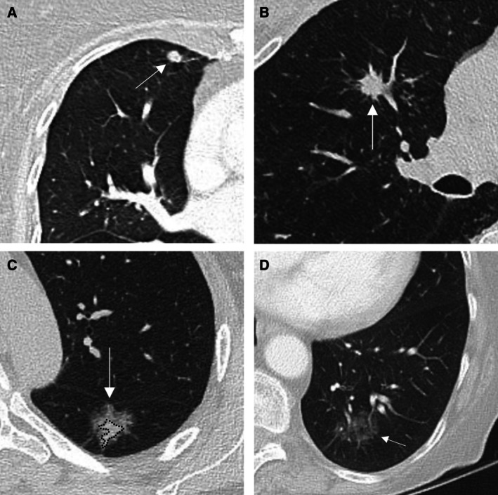 The TSANZ Practical Guide for Clinicians in the Management of Screen- and Incidentally-Detected Nodules.