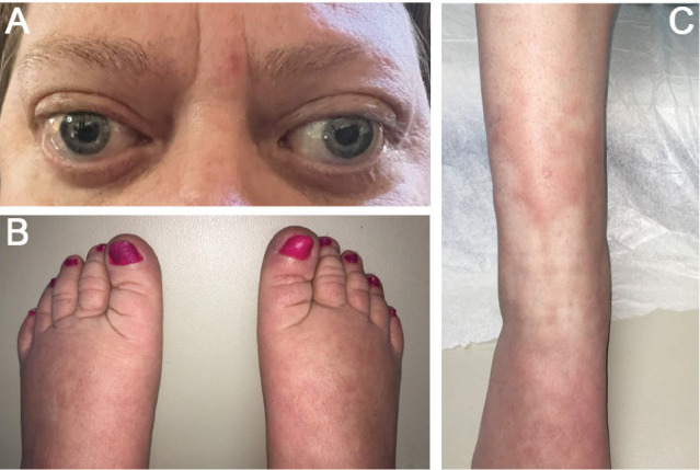 Resolution of Thyroid Acropachy in a Patient Treated With Teprotumumab: A Case Report and Review of Mechanisms.