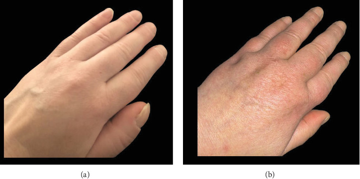 Resolution of Thyroid Acropachy in a Patient Treated With Teprotumumab: A Case Report and Review of Mechanisms.