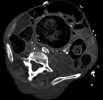 Colocaval Fistula: A Unique Case Report.