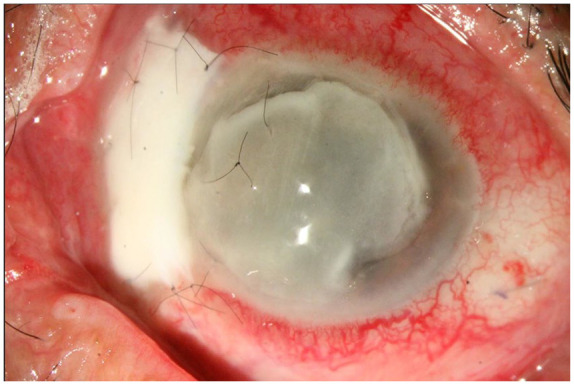 Infectious scleritis: a comprehensive narrative review of epidemiology, clinical characteristics, and management strategies.
