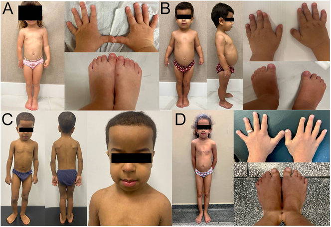 From genotype to phenotype: the impact of early management in pycnodysostosis.