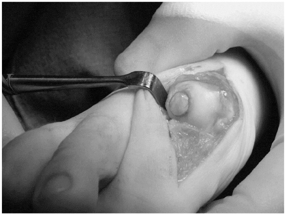 Surgical Treatment of Symptomatic Osteochondral Lesions of the Foot: A Contemporary Review.